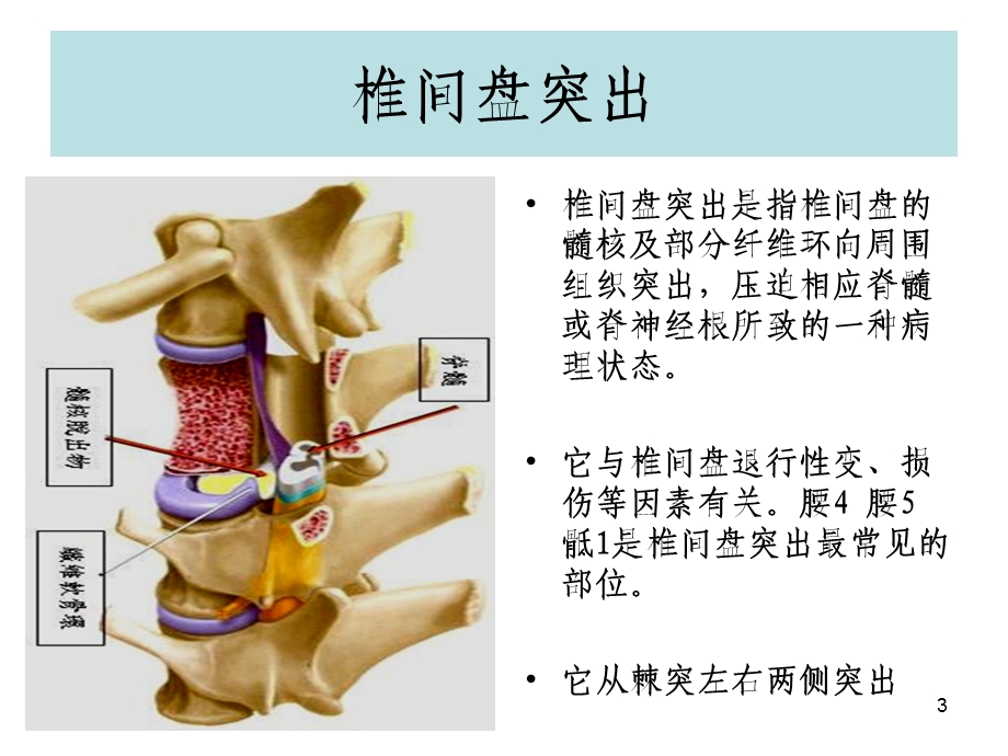 (腰椎间盘突出与腰肌劳损)运动康复幻灯片ppt课件.ppt_第3页