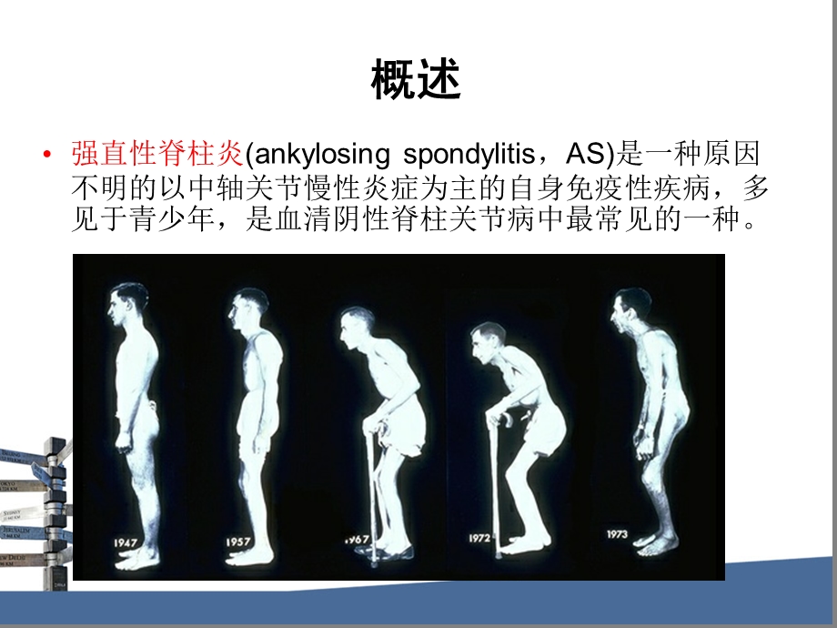 骶髂关节炎的评分比较影像课件.ppt_第2页