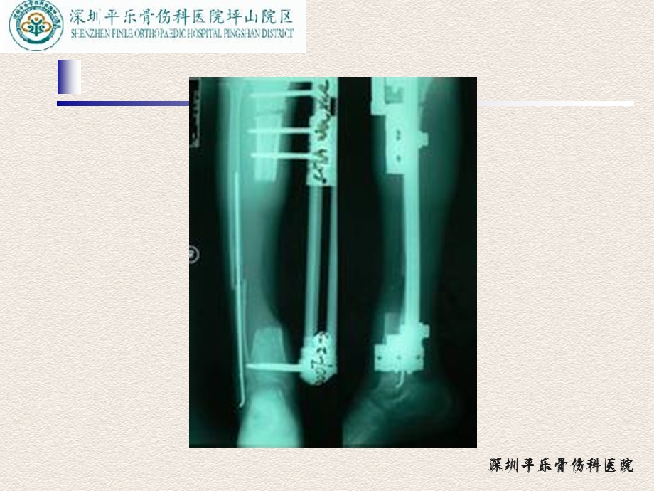 Masquelet技术参考ppt课件.ppt_第2页