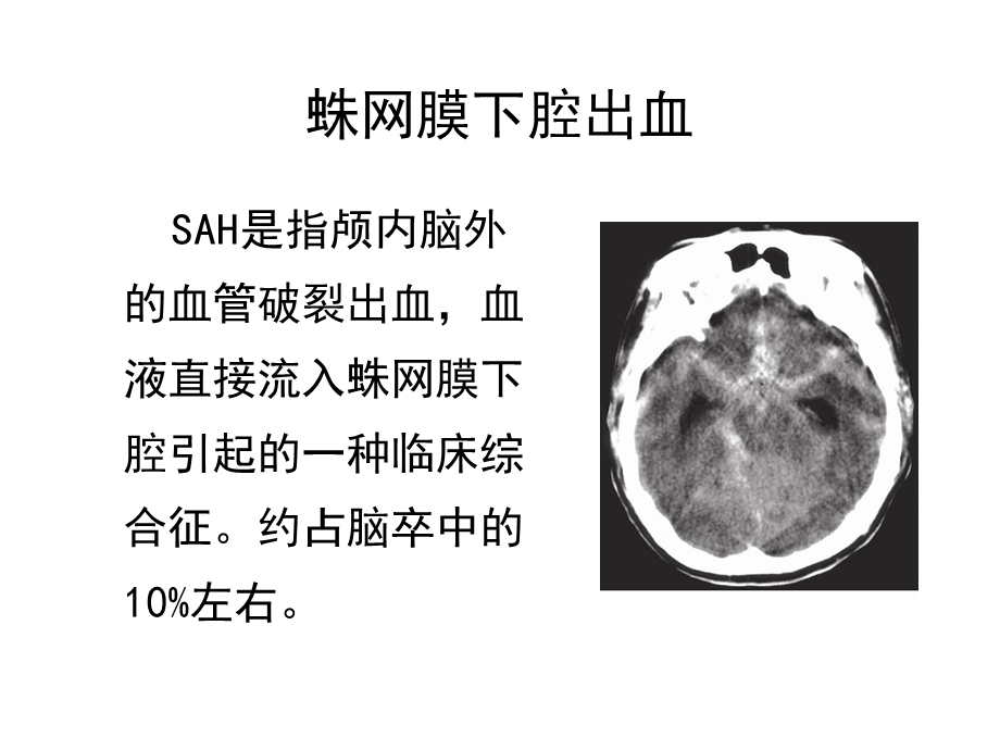 动脉瘤性蛛网膜下腔出血诊治医学ppt课件.ppt_第3页