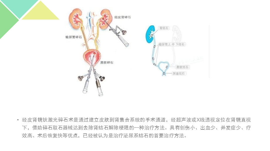 经皮肾镜钬激光碎石术的护理配合课件.pptx_第2页