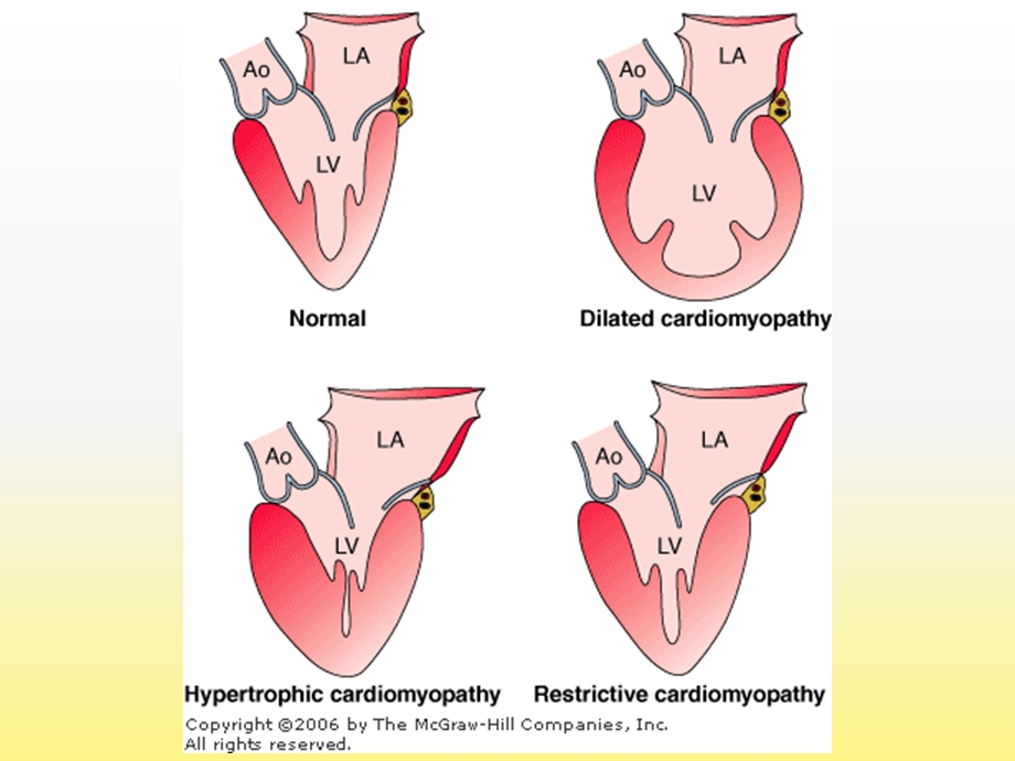 心肌炎心肌病ppt课件2011.ppt_第3页