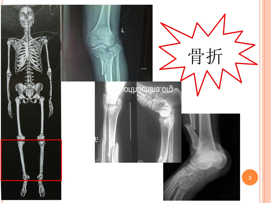 胫腓骨骨折复位术手术配合课件.ppt_第3页