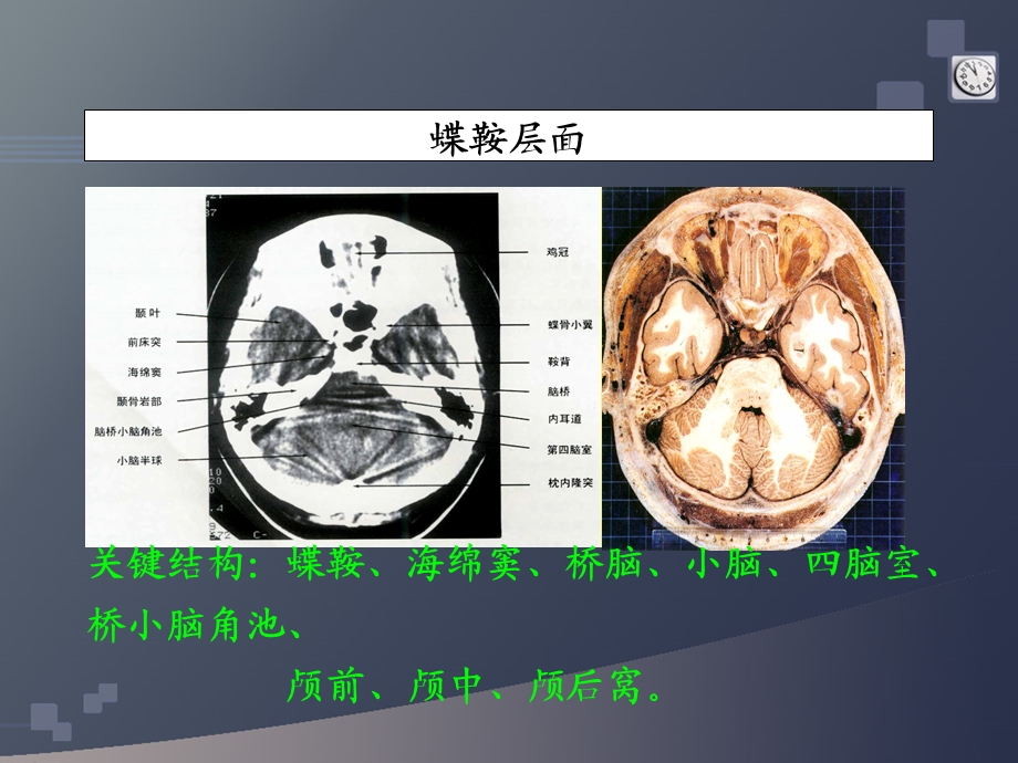 研究生医学影像学-颅脑4-中枢神经系统-星形细胞瘤课件.ppt_第3页