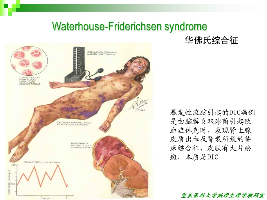 弥散性血管内凝血(病生)课件.ppt_第3页