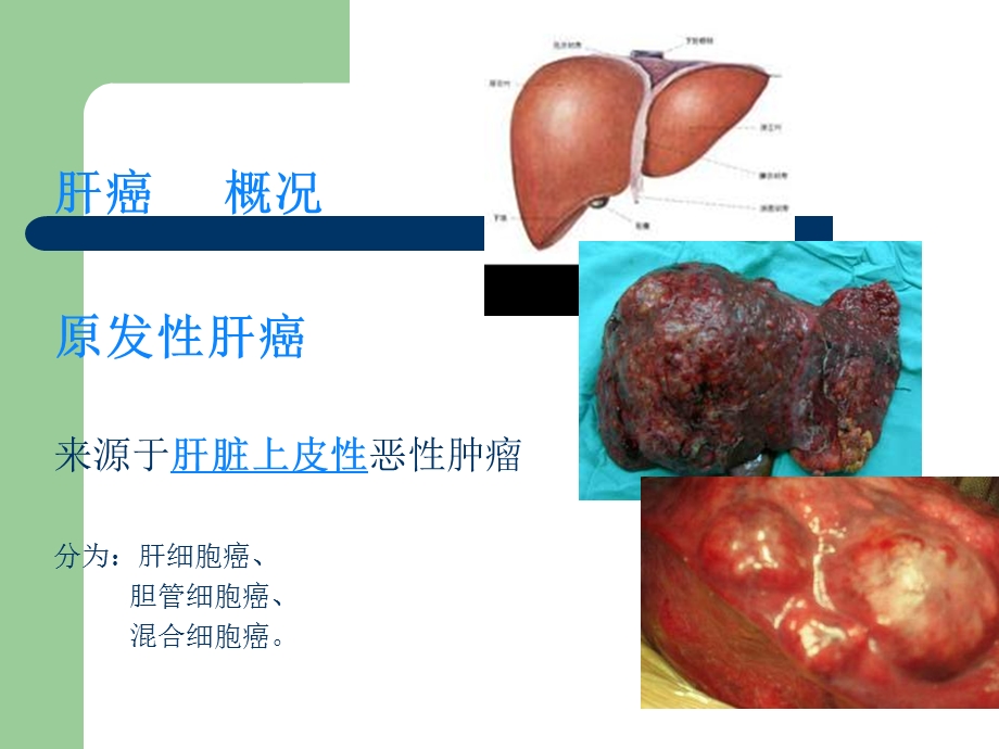 肿瘤介入治疗护理课件.ppt_第2页