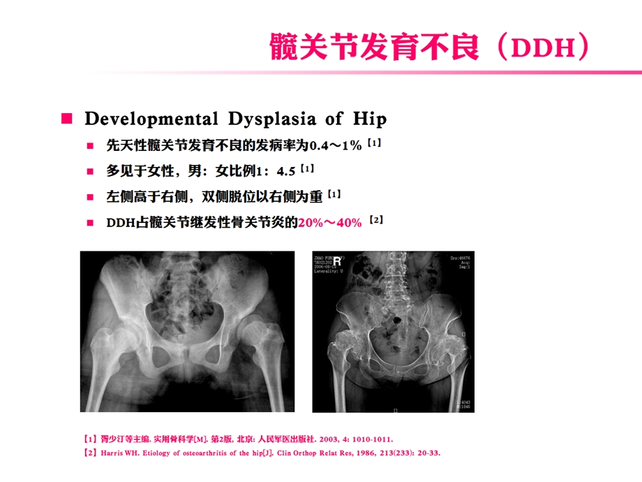 表面置换术治疗髋关节发育不良-课件.ppt_第2页