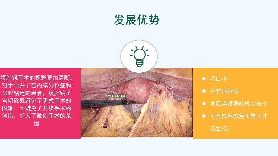 腹腔镜下全宫切--护理查房课件.pptx_第3页