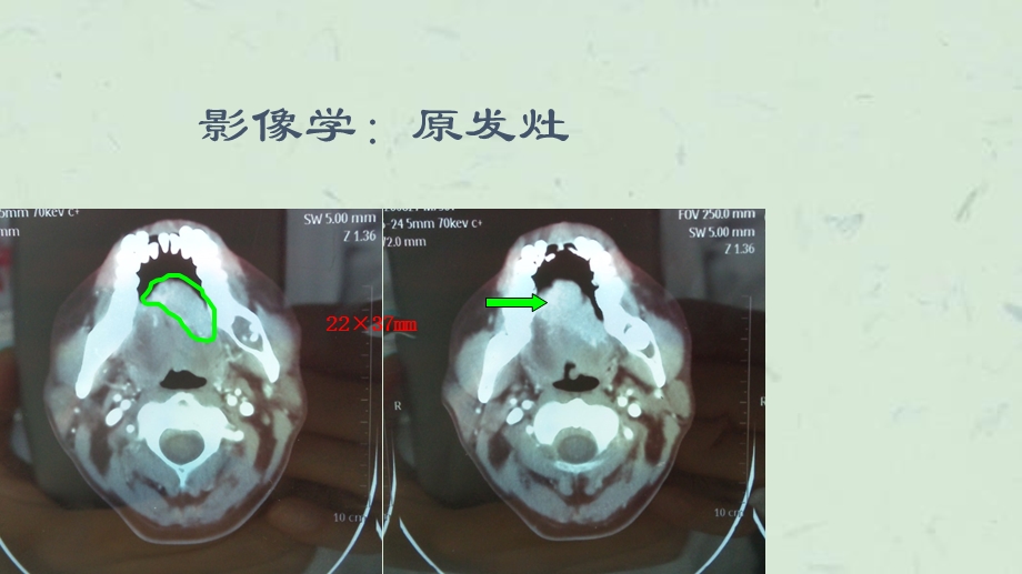 舌癌病例讨论ppt课件.ppt_第3页