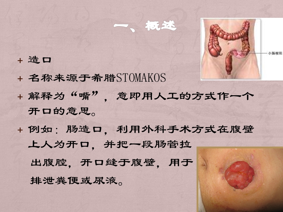 造口并发症的处理课件.ppt_第1页