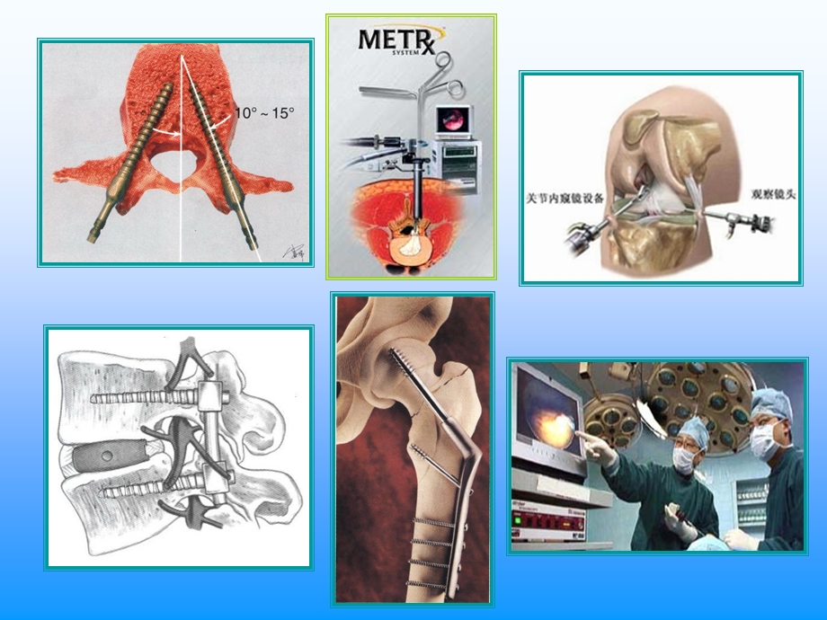 骨折固定与相关并发症课件.ppt_第3页