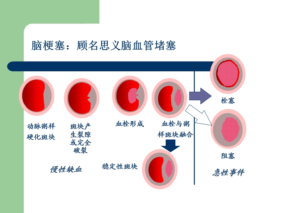 急性脑梗死的治疗原则精要课件.ppt_第3页