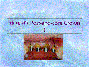 桩核冠 贴面_课件.ppt