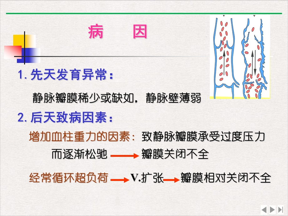 静脉曲张的相关知识和预防措施课件.pptx_第3页