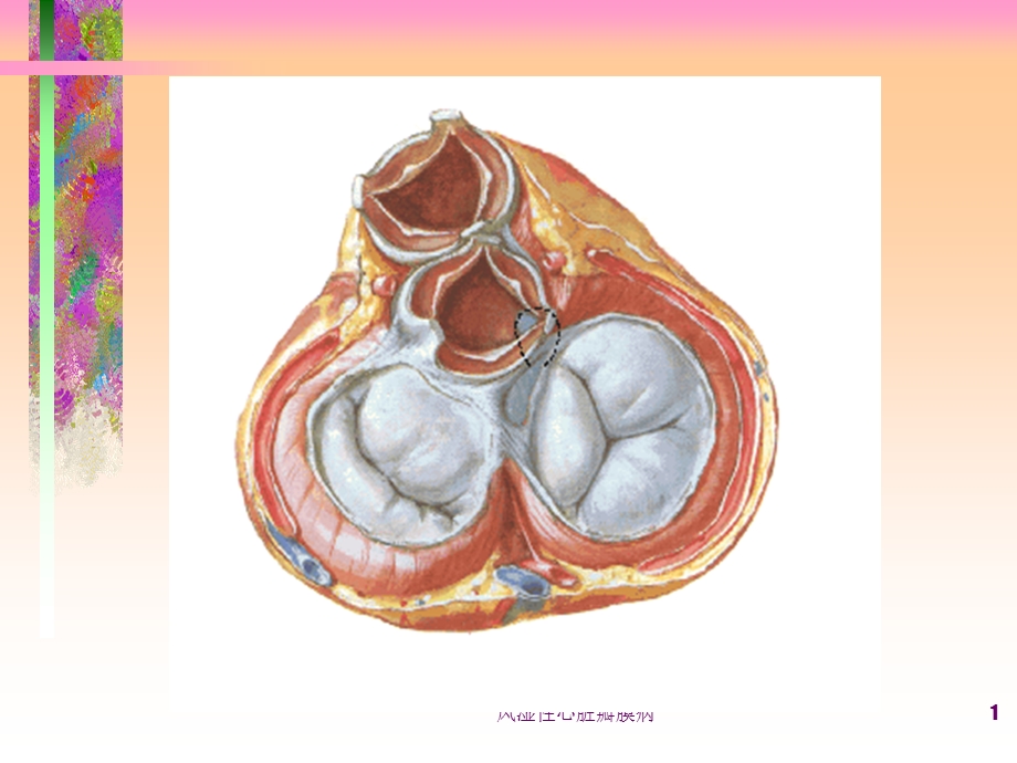 风湿性心脏瓣膜病ppt课件.ppt_第1页