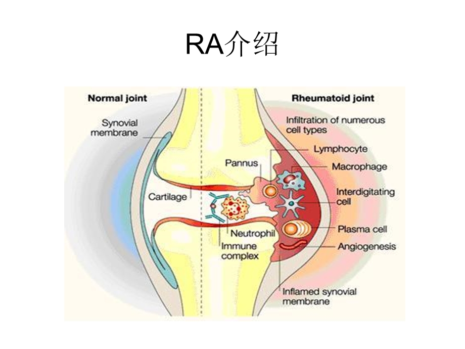 类风湿关节炎ra发病机制 课件.ppt_第3页