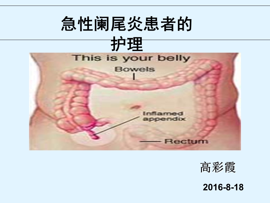 急性阑尾炎患者的护理 ppt课件.ppt_第1页