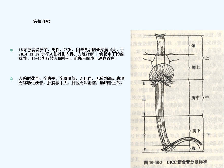 食道癌个案护理课件.ppt_第2页