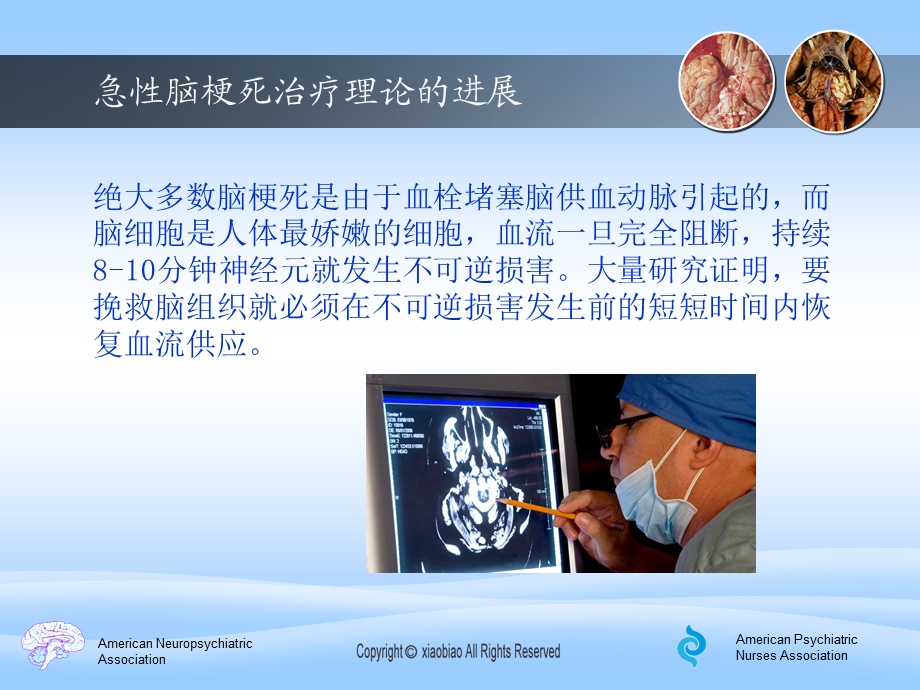 急性脑梗规范治疗死课件.ppt_第3页