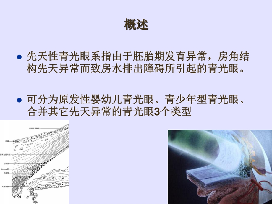 先天性青光眼课件.ppt_第2页