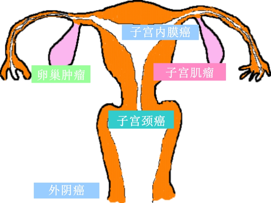 生殖系统肿瘤患者的护理课件.ppt_第3页