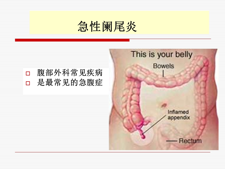 急性阑尾炎的诊治课件.ppt_第1页