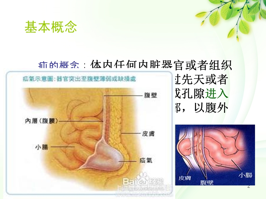 腹股沟疝病人的护理课件.ppt_第2页