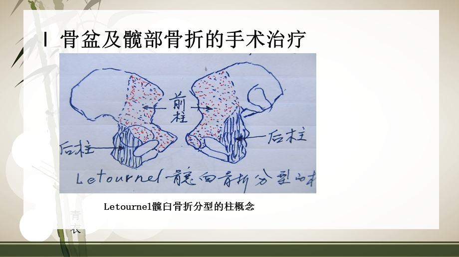 髋部手术的几个问题课件.ppt_第2页