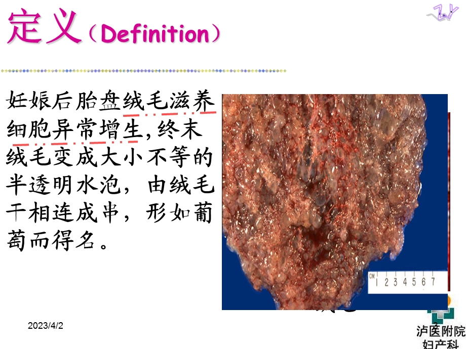 妇产科护理ppt课件_妊娠滋养细胞疾病.ppt_第3页