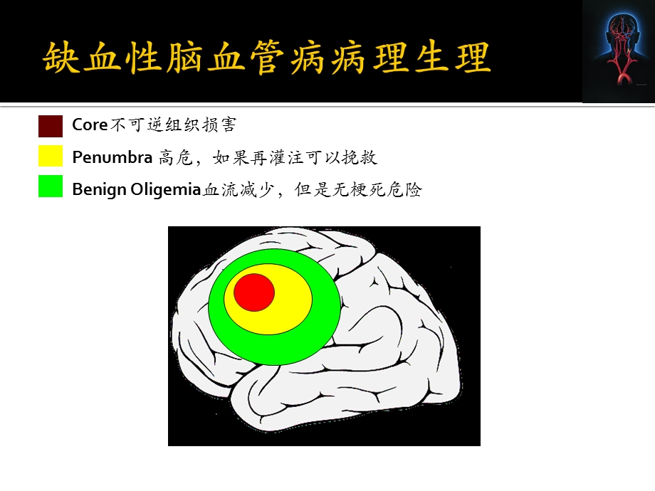 缺血性卒中病因及发病机制的分型课件.pptx_第3页