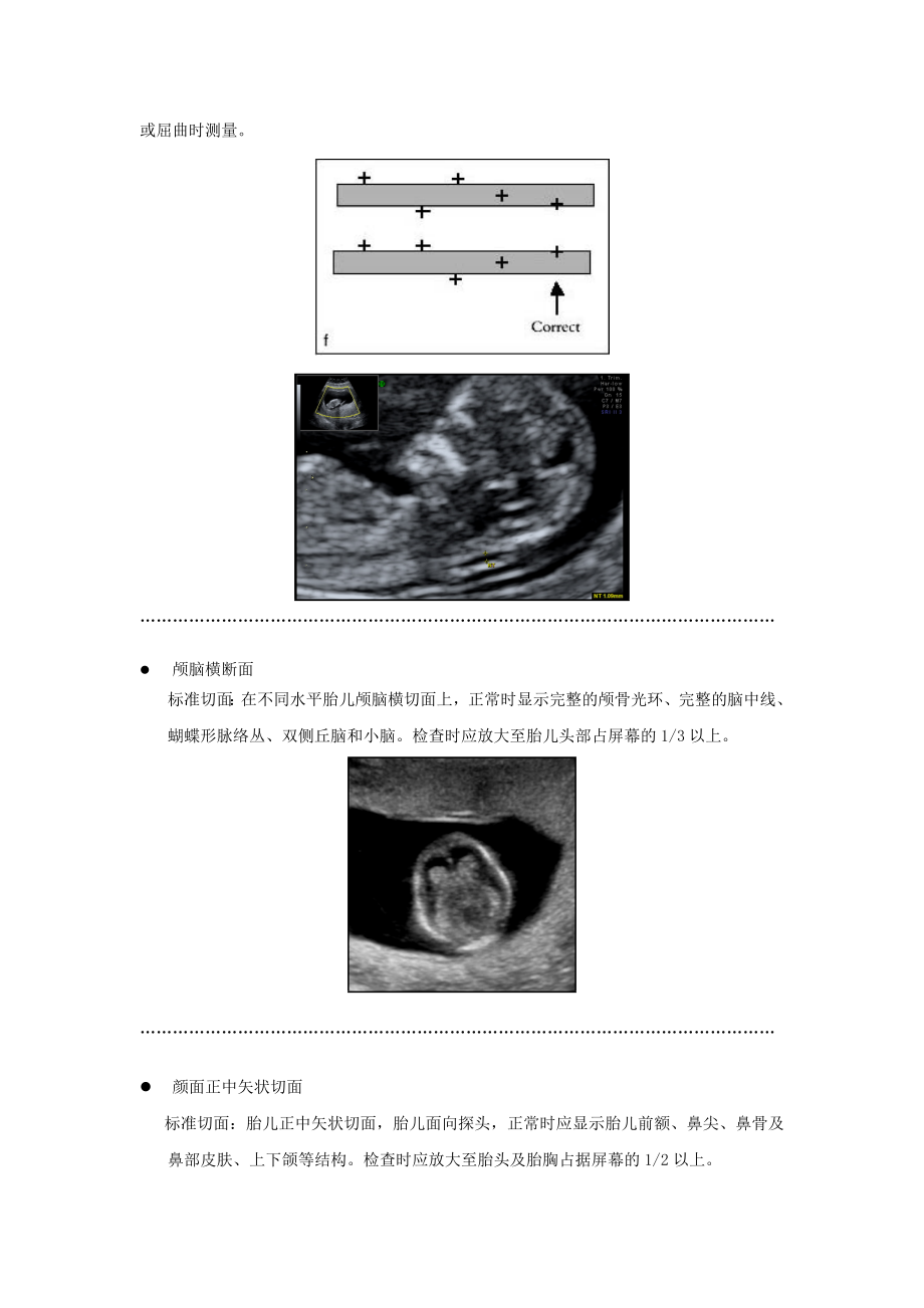 胎儿标准测量切面.doc_第2页