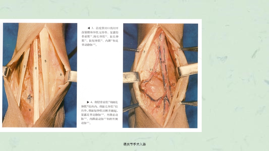 踝关节手术入路ppt课件.ppt_第3页