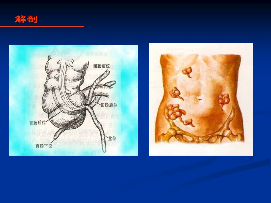 急性阑尾炎 课件.ppt_第2页