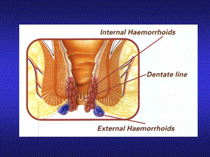 结直肠与肛门疾病疾病课件.ppt