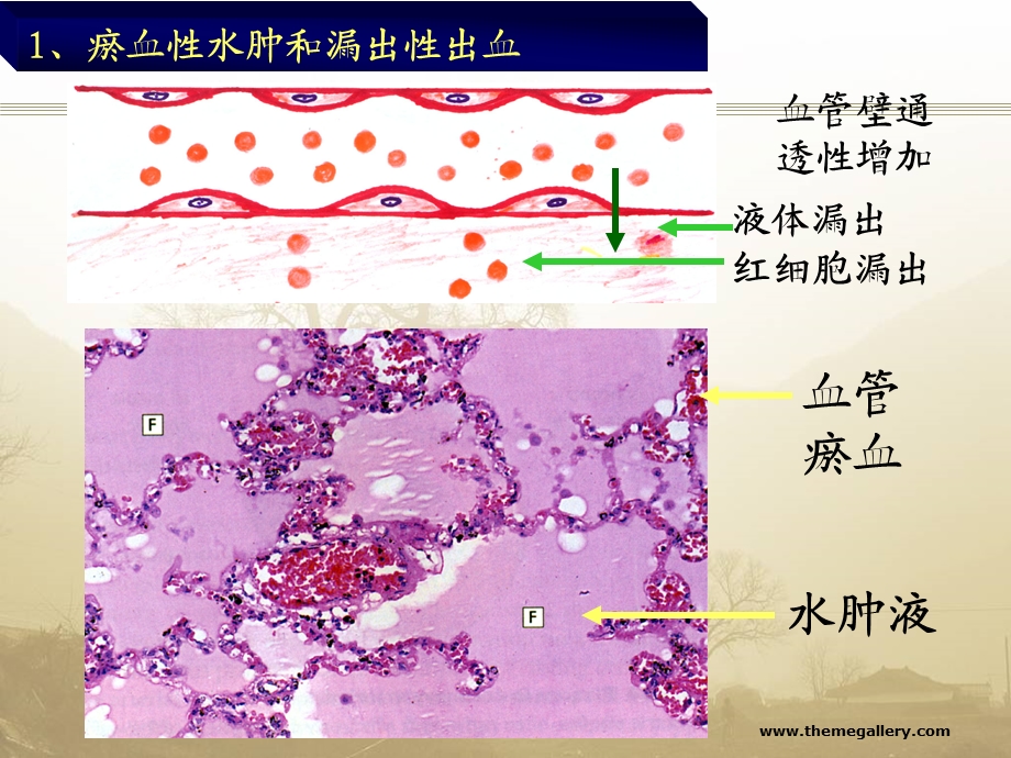 实习-局部血液循环障碍课件.ppt_第3页