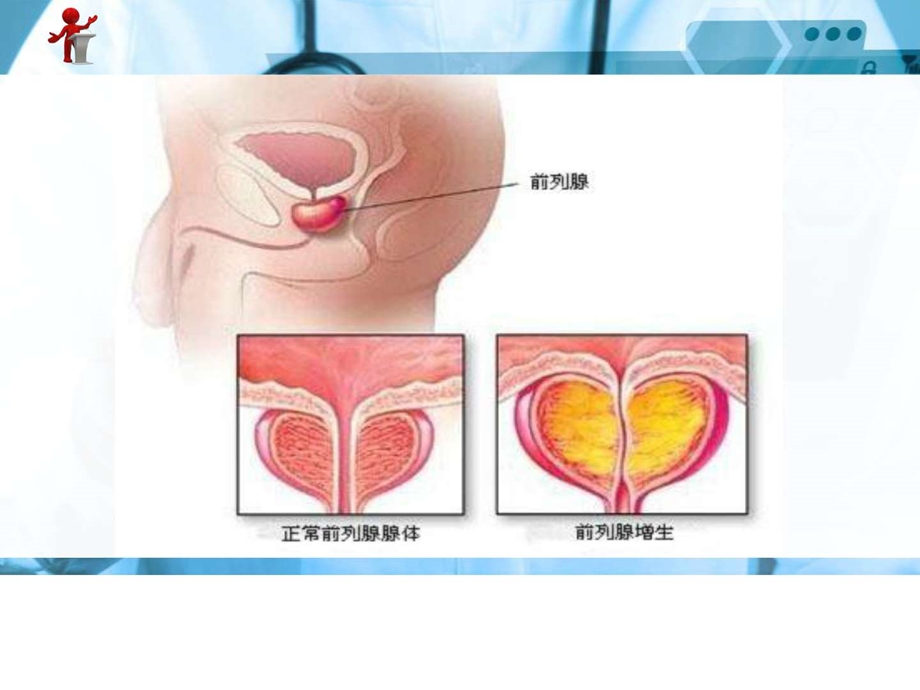 良性前列腺增生病人的护理ppt课件.ppt_第3页