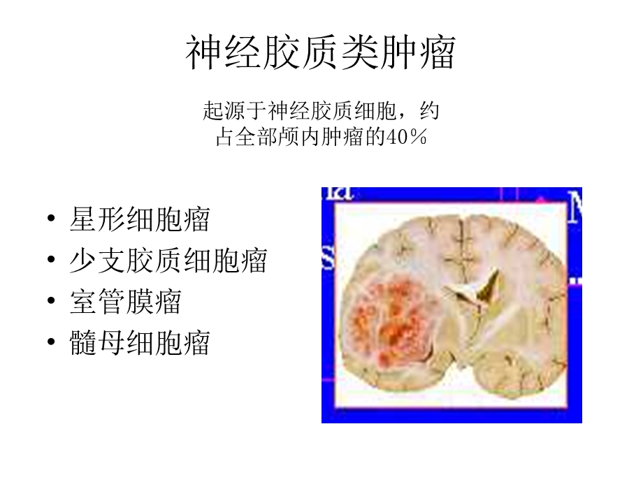 星形细胞瘤CT诊断课件.ppt_第1页