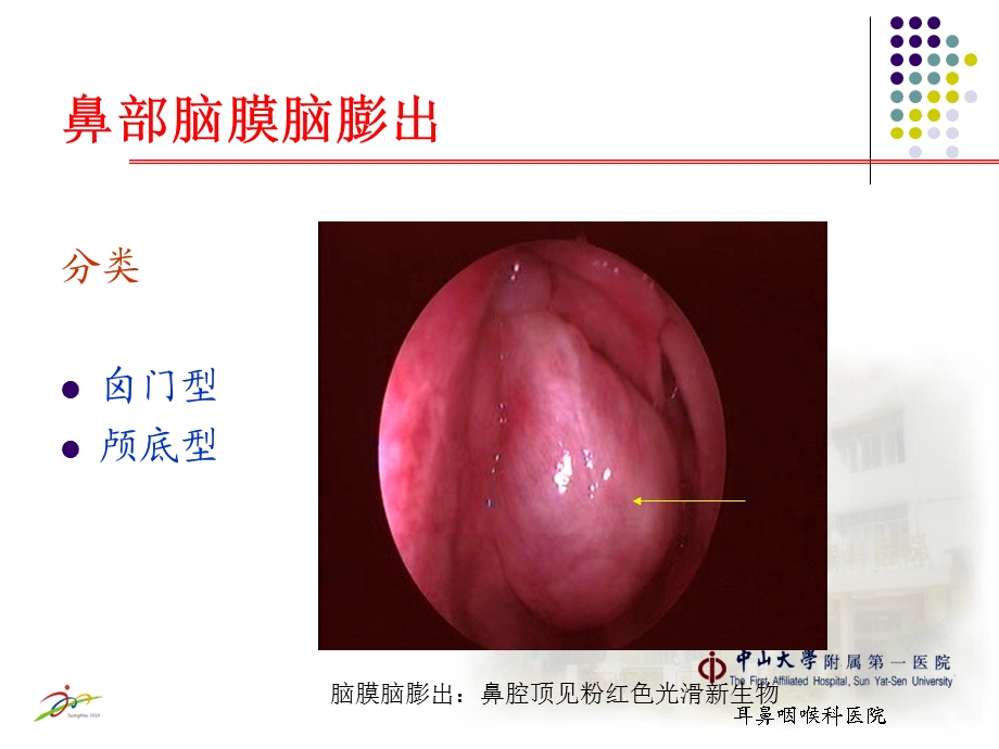 鼻部先天性疾病课件.ppt_第3页