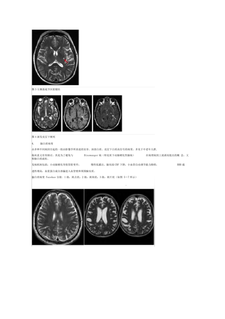 一文读懂：脑小血管病影像与临床七大要点.docx_第3页