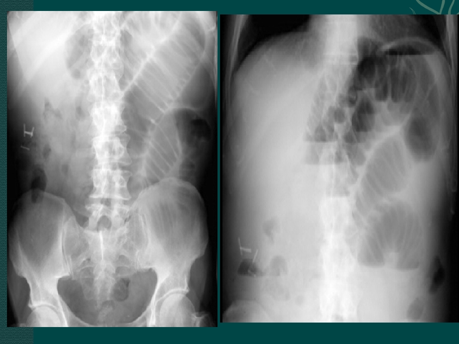 单纯性肠梗阻影像学分析.pptx_第2页