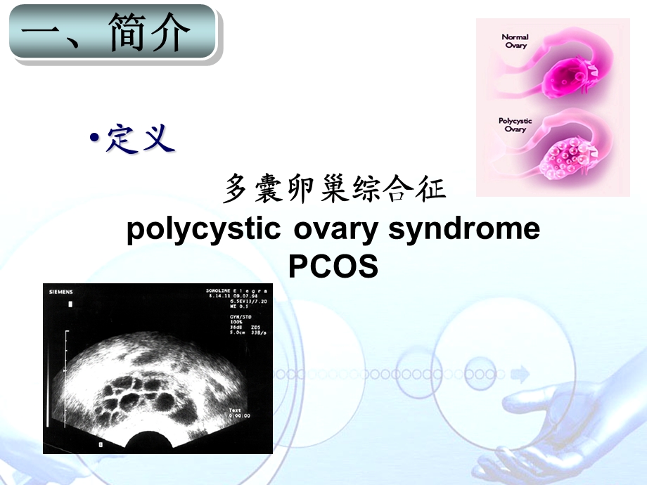 多囊卵巢综合征PCOS .ppt_第3页