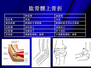 肱骨髁上骨折文档资料.ppt