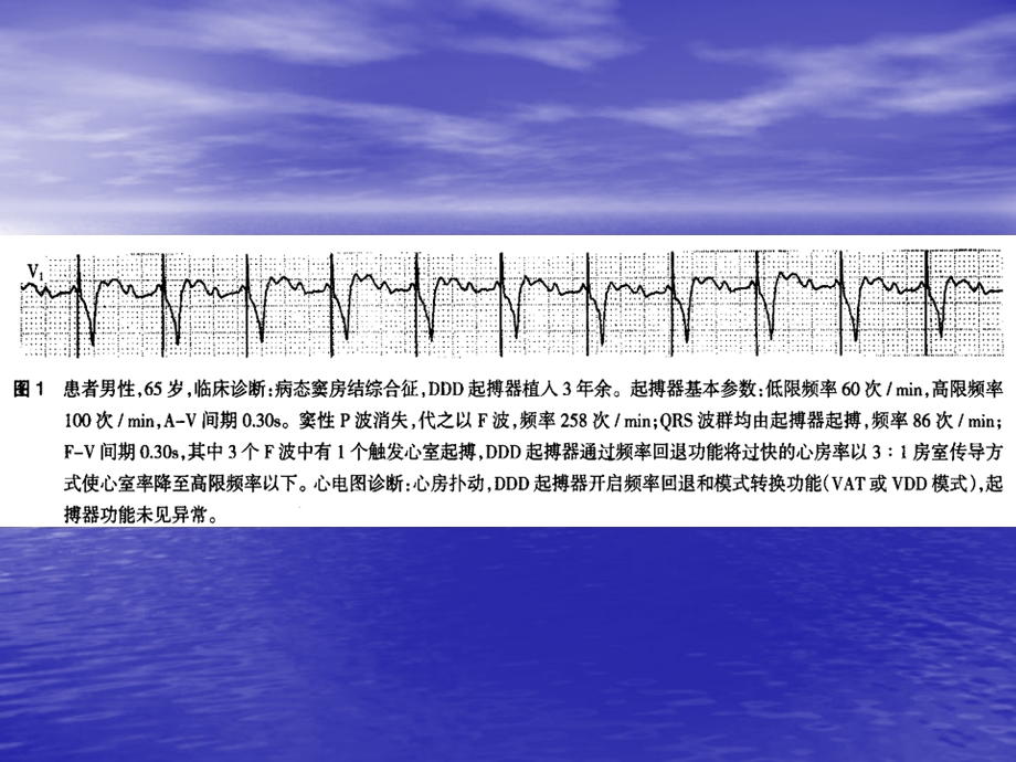 起搏器心电图简释常州第二人民医院刘敏文档资料.ppt_第2页