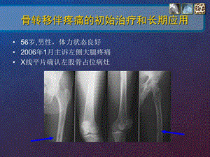 肺癌骨转移病例讨论规范用药ppt课件文档资料.ppt