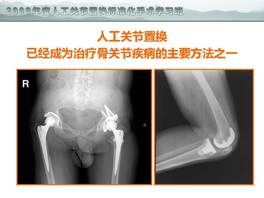 关节置换的围手术期精细化管理文档资料.ppt_第1页