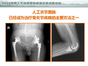 关节置换的围手术期精细化管理文档资料.ppt