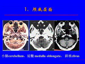 中枢神经系统疾病影像诊断第一部分ppt课件文档资料.ppt