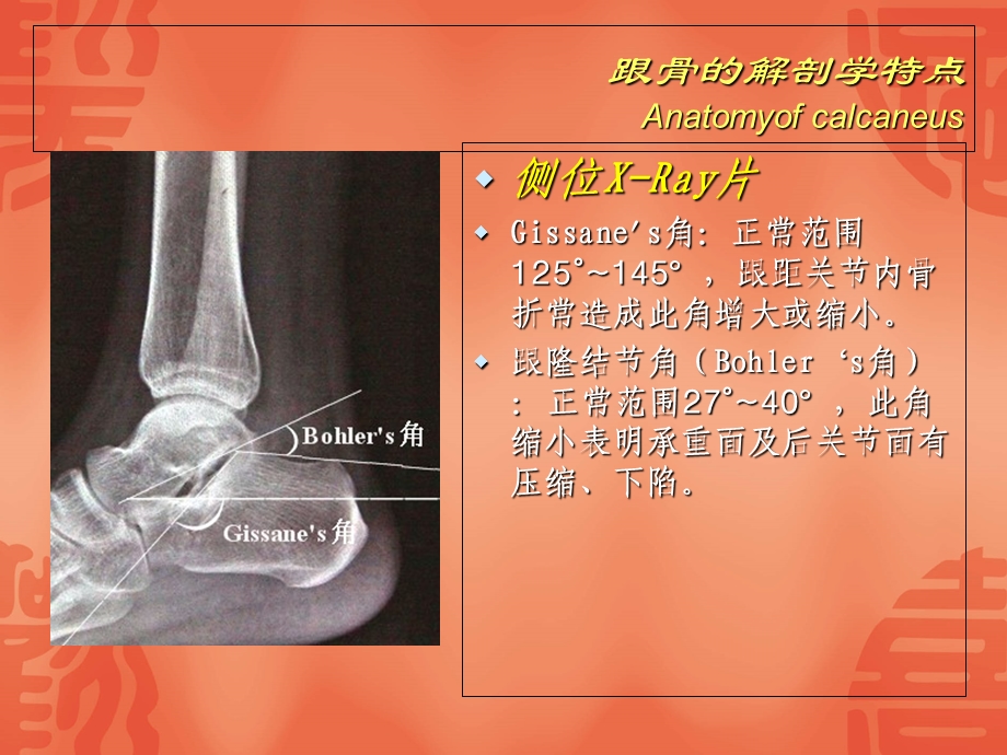 跟骨骨折分型与治疗讲座文档资料.ppt_第2页