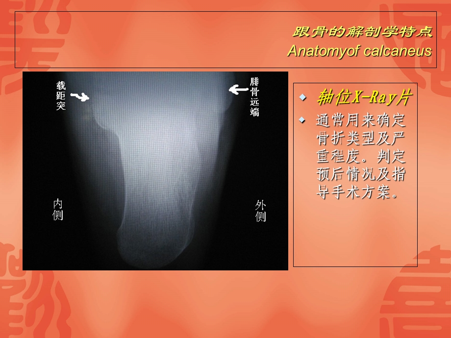 跟骨骨折分型与治疗讲座文档资料.ppt_第3页