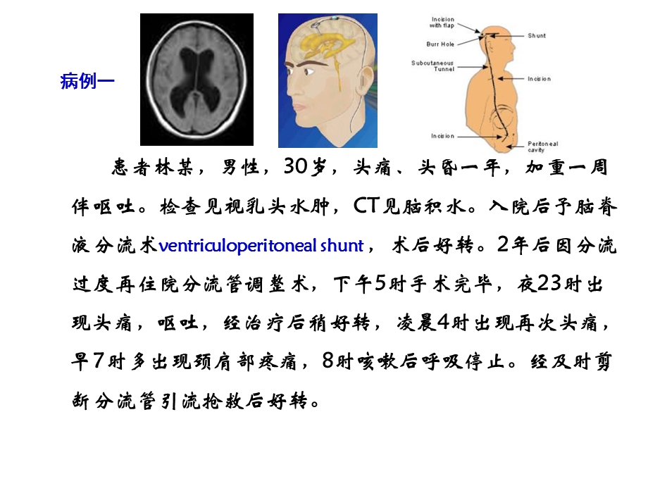 临床颅内压增高精选文档.ppt_第1页